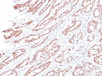 RB1 / Retinoblastoma / RB Antibody - IHC testing of human colon with Rb antibody (clone 1F8). Required HIER: boil tissue sections in 10mM citrate buffer, pH 6, for 10-20 min followed by cooling at RT for 20 min.