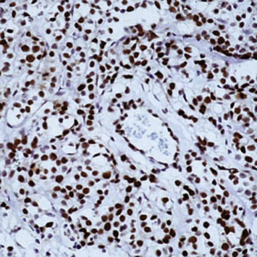 RB1 / Retinoblastoma / RB Antibody - Formalin-fixed, paraffin-embedded human colon carcinoma stained with Retinoblastoma protein antibody.