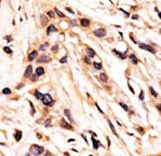 RB1 / Retinoblastoma / RB Antibody - Formalin-fixed and paraffin-embedded human cancer tissue reacted with the primary antibody, which was peroxidase-conjugated to the secondary antibody, followed by AEC staining. This data demonstrates the use of this antibody for immunohistochemistry; clinical relevance has not been evaluated. BC = breast carcinoma; HC = hepatocarcinoma.