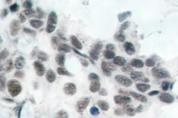 RB1 / Retinoblastoma / RB Antibody - IHC of p-Rb (S780) pAb in paraffin-embedded human breast carcinoma tissue.