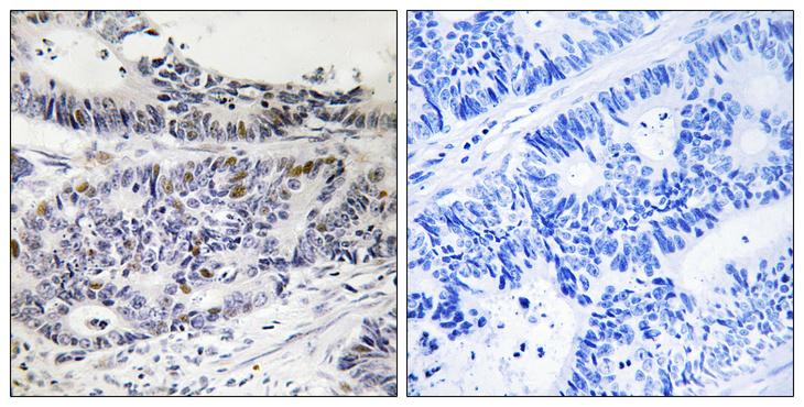 RB1 / Retinoblastoma / RB Antibody - P-peptide - + Immunohistochemistry analysis of paraffin-embedded human colon carcinoma tissue, using Retinoblastoma (Phospho-Ser788) antibody.