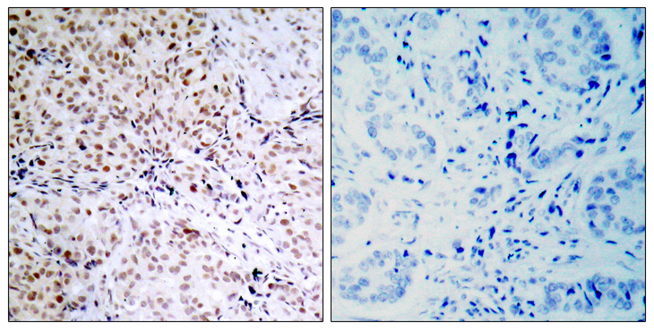 RB1 / Retinoblastoma / RB Antibody - Immunohistochemistry analysis of paraffin-embedded human breast carcinoma, using Retinoblastoma (Phospho-Ser795) Antibody. The picture on the right is blocked with the phospho peptide.