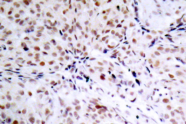 RB1 / Retinoblastoma / RB Antibody - IHC of p-Rb (S795) pAb in paraffin-embedded human breast carcinoma tissue.