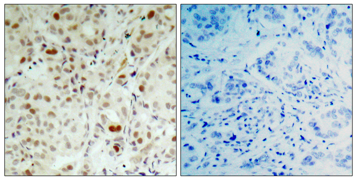 RB1 / Retinoblastoma / RB Antibody - Immunohistochemistry analysis of paraffin-embedded human breast carcinoma, using Retinoblastoma (Phospho-Ser807) Antibody. The picture on the right is blocked with the phospho peptide.
