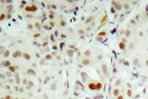 RB1 / Retinoblastoma / RB Antibody - IHC of p-Rb (S807) pAb in paraffin-embedded human breast carcinoma tissue.