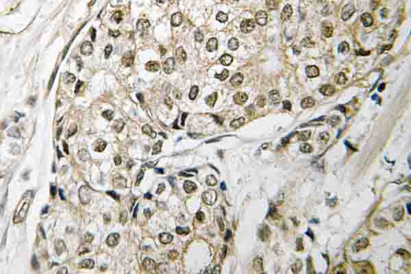 RB1 / Retinoblastoma / RB Antibody - IHC of Rb (T601) pAb in paraffin-embedded human breast carcinoma tissue.