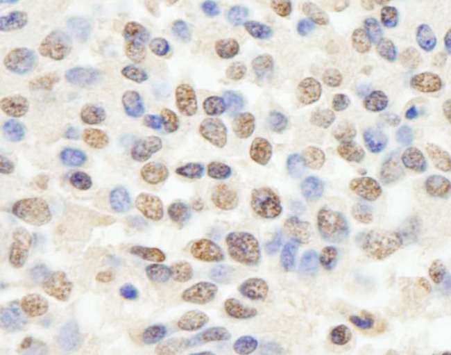 RBBP4 / RBAP48 Antibody - Detection of Human RBBP4/RbAp48 by Immunohistochemistry. Sample: FFPE section of human Ewing sarcoma. Antibody: Affinity purified rabbit anti-RBBP4/RbAp48 used at a dilution of 1:200 (1 ug/ml). Detection: DAB.