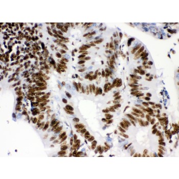 RBBP4 / RBAP48 Antibody - RbAp48 antibody IHC-paraffin. IHC(P): Human Intestinal Cancer Tissue.