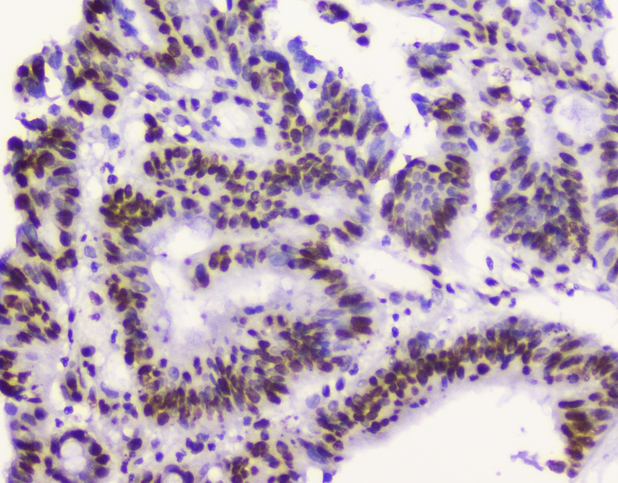 RBBP4 / RBAP48 Antibody - IHC analysis of RbAp48 using anti-RbAp48 antibody. RbAp48 was detected in paraffin-embedded section of human intestinal cancer tissue. Heat mediated antigen retrieval was performed in citrate buffer (pH6, epitope retrieval solution) for 20 mins. The tissue section was blocked with 10% goat serum. The tissue section was then incubated with 2µg/ml mouse anti-RbAp48 antibody overnight at 4°C. Biotinylated goat anti-mouse IgG was used as secondary antibody and incubated for 30 minutes at 37°C. The tissue section was developed using Strepavidin-Biotin-Complex (SABC) with DAB as the chromogen.
