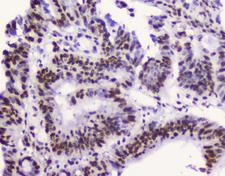 RBBP4 / RBAP48 Antibody - IHC analysis of RbAp48 using anti-RbAp48 antibody. RbAp48 was detected in paraffin-embedded section of human intestinal cancer tissue. Heat mediated antigen retrieval was performed in citrate buffer (pH6, epitope retrieval solution) for 20 mins. The tissue section was blocked with 10% goat serum. The tissue section was then incubated with 2µg/ml mouse anti-RbAp48 antibody overnight at 4°C. Biotinylated goat anti-mouse IgG was used as secondary antibody and incubated for 30 minutes at 37°C. The tissue section was developed using Strepavidin-Biotin-Complex (SABC) with DAB as the chromogen.