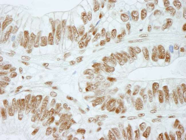 RBBP5 Antibody - Detection of Human RbBP5 by Immunohistochemistry. Sample: FFPE section of human colon adenocarcinoma. Antibody: Affinity purified rabbit anti-RbBP5 used at a dilution of 1:250.