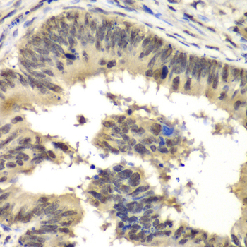 RBBP5 Antibody - Immunohistochemistry of paraffin-embedded human colon carcinoma tissue.