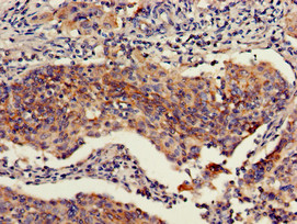 RBBP6 Antibody - Immunohistochemistry of paraffin-embedded human cervical cancer using RBBP6 Antibody at dilution of 1:100