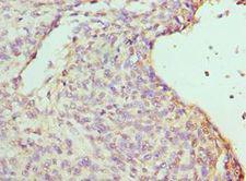 RBBP7 / RbAp46 Antibody - Immunohistochemistry of paraffin-embedded human endometrial cancer using antibody at 1:100 dilution.