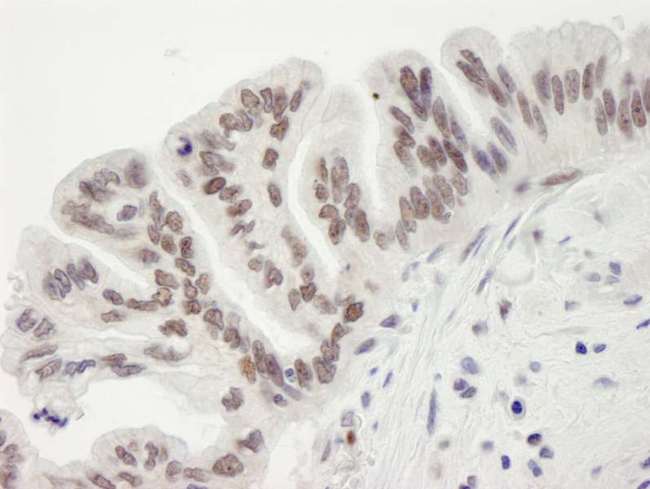 RBBP7 / RbAp46 Antibody - Detection of Human RBBP7 by Immunohistochemistry. Sample: FFPE section of human ovarian tumor. Antibody: Affinity purified rabbit anti-RBBP7 used at a dilution of 1:250.