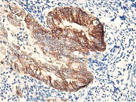 RBBP7 / RbAp46 Antibody - IHC of paraffin-embedded Adenocarcinoma of Human endometrium tissue using anti-RBBP7 mouse monoclonal antibody. (Heat-induced epitope retrieval by 10mM citric buffer, pH6.0, 100C for 10min).