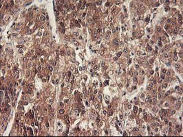 RBBP7 / RbAp46 Antibody - IHC of paraffin-embedded Carcinoma of Human liver tissue using anti-RBBP7 mouse monoclonal antibody.