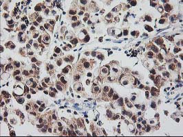 RBBP7 / RbAp46 Antibody - IHC of paraffin-embedded Carcinoma of Human lung tissue using anti-RBBP7 mouse monoclonal antibody.