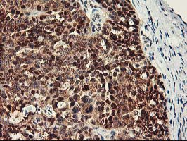 RBBP7 / RbAp46 Antibody - IHC of paraffin-embedded Adenocarcinoma of Human ovary tissue using anti-RBBP7 mouse monoclonal antibody.