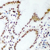 RBBP7 / RbAp46 Antibody - Immunohistochemical analysis of RbAp46 staining in human gastric cancer formalin fixed paraffin embedded tissue section. The section was pre-treated using heat mediated antigen retrieval with sodium citrate buffer (pH 6.0). The section was then incubated with the antibody at room temperature and detected using an HRP conjugated compact polymer system. DAB was used as the chromogen. The section was then counterstained with hematoxylin and mounted with DPX.
