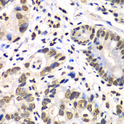 RBBP7 / RbAp46 Antibody - Immunohistochemistry of paraffin-embedded human gastric cancer using RBBP7 antibody at dilution of 1:100 (40x lens).