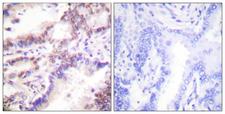 RBBP8 / CTIP Antibody - Immunohistochemistry analysis of paraffin-embedded human lung carcinoma tissue, using CTIP Antibody. The picture on the right is blocked with the synthesized peptide.