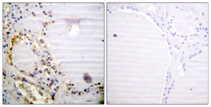 RBBP8 / CTIP Antibody - Immunohistochemistry analysis of paraffin-embedded human thyroid gland tissue, using RBBP8 Antibody. The picture on the right is blocked with the synthesized peptide.