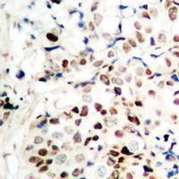 RBBP8 / CTIP Antibody - Immunohistochemical analysis of CTIP staining in human breast cancer formalin fixed paraffin embedded tissue section. The section was pre-treated using heat mediated antigen retrieval with sodium citrate buffer (pH 6.0). The section was then incubated with the antibody at room temperature and detected using an HRP conjugated compact polymer system. DAB was used as the chromogen. The section was then counterstained with hematoxylin and mounted with DPX.