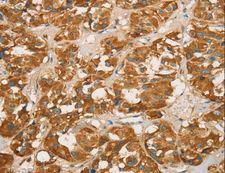 RBBP8 / CTIP Antibody - Immunohistochemistry of paraffin-embedded Human gastric cancer using RBBP8 Polyclonal Antibody at dilution of 1:65.