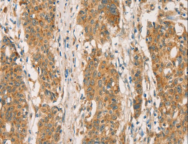 RBBP8 / CTIP Antibody - Immunohistochemistry of paraffin-embedded Human gastric cancer using RBBP8 Polyclonal Antibody at dilution of 1:65.