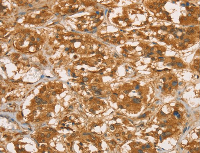 RBBP8 / CTIP Antibody - Immunohistochemistry of paraffin-embedded Human breast cancer using RBBP8 Polyclonal Antibody at dilution of 1:45.