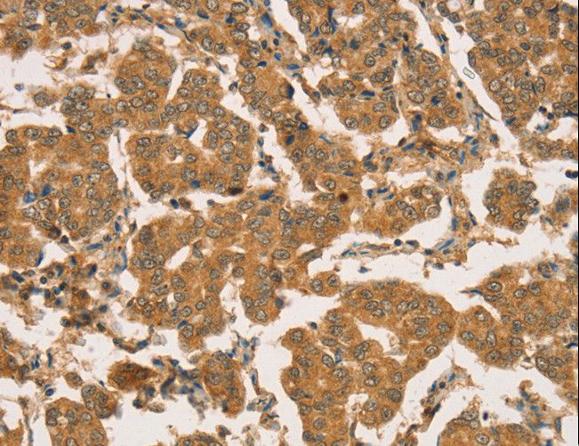 RBBP8 / CTIP Antibody - Immunohistochemistry of paraffin-embedded Human breast cancer using RBBP8 Polyclonal Antibody at dilution of 1:45.