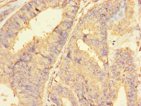 RBBP8 / CTIP Antibody - Immunohistochemistry of paraffin-embedded human endometrial cancer tissue using RBBP8 Antibody at dilution of 1:100