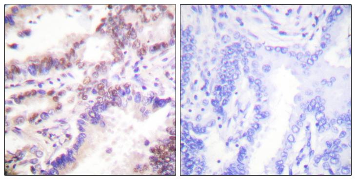 RBBP8 / CTIP Antibody - Peptide - + Immunohistochemistry analysis of paraffin-embedded human lung carcinoma tissue using CTIP antibody.