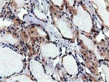 RBBP9 Antibody - Immunohistochemical staining of paraffin-embedded Carcinoma of Human thyroid tissue using anti-RBBP9 mouse monoclonal antibody.