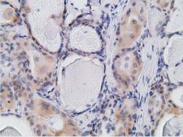 RBBP9 Antibody - Immunohistochemical staining of paraffin-embedded Carcinoma of Human thyroid tissue using anti-RBBP9 mouse monoclonal antibody. (Dilution 1:50).