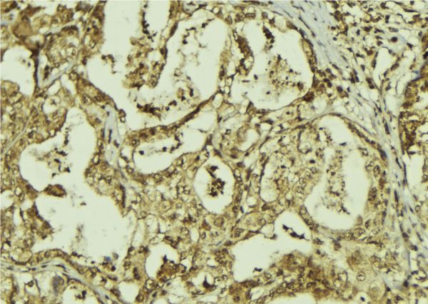 RBBP9 Antibody - 1:100 staining human breast carcinoma tissue by IHC-P. The sample was formaldehyde fixed and a heat mediated antigen retrieval step in citrate buffer was performed. The sample was then blocked and incubated with the antibody for 1.5 hours at 22°C. An HRP conjugated goat anti-rabbit antibody was used as the secondary.
