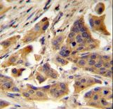 RBCK1 Antibody - RBCK1 (UBCE7IP3) Antibody immunohistochemistry of formalin-fixed and paraffin-embedded human bladder carcinoma followed by peroxidase-conjugated secondary antibody and DAB staining.This data demonstrates the use of RBCK1 (UBCE7IP3) Antibody for immunohistochemistry.