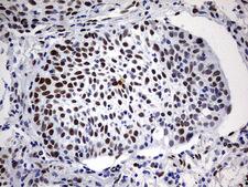 RBFOX1 / A2BP1 Antibody - IHC of paraffin-embedded Carcinoma of Human lung tissue using anti-RBFOX1 mouse monoclonal antibody. (Heat-induced epitope retrieval by 1 mM EDTA in 10mM Tris, pH8.5, 120°C for 3min).