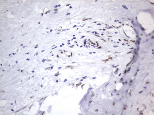 RBFOX1 / A2BP1 Antibody - IHC of paraffin-embedded Carcinoma of Human liver tissue using anti-RBFOX1 mouse monoclonal antibody. (Heat-induced epitope retrieval by 1 mM EDTA in 10mM Tris, pH8.5, 120°C for 3min).