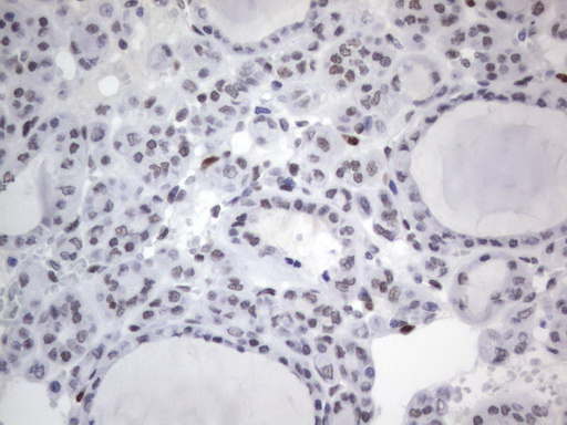 RBFOX1 / A2BP1 Antibody - IHC of paraffin-embedded Carcinoma of Human thyroid tissue using anti-RBFOX1 mouse monoclonal antibody. (Heat-induced epitope retrieval by 1 mM EDTA in 10mM Tris, pH8.5, 120°C for 3min).