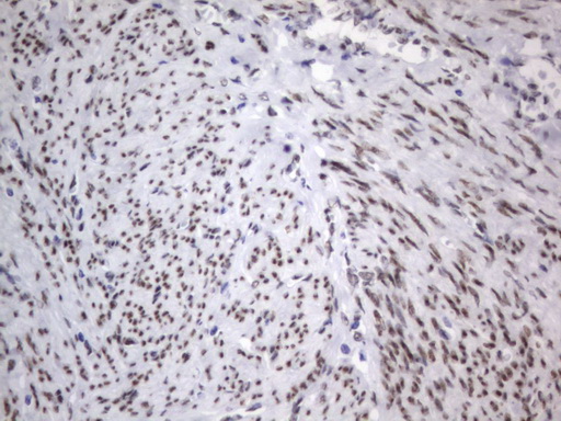RBFOX1 / A2BP1 Antibody - IHC of paraffin-embedded Adenocarcinoma of Human endometrium tissue using anti-RBFOX1 mouse monoclonal antibody. (Heat-induced epitope retrieval by 1 mM EDTA in 10mM Tris, pH8.5, 120°C for 3min).
