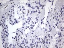 RBFOX1 / A2BP1 Antibody - IHC of paraffin-embedded Adenocarcinoma of Human breast tissue using anti-RBFOX1 mouse monoclonal antibody. (Heat-induced epitope retrieval by 1 mM EDTA in 10mM Tris, pH8.5, 120°C for 3min).