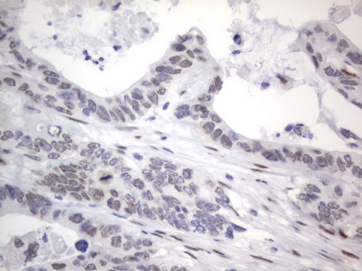 RBFOX1 / A2BP1 Antibody - IHC of paraffin-embedded Adenocarcinoma of Human colon tissue using anti-RBFOX1 mouse monoclonal antibody. (Heat-induced epitope retrieval by 1 mM EDTA in 10mM Tris, pH8.5, 120°C for 3min).