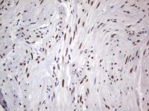 RBFOX1 / A2BP1 Antibody - IHC of paraffin-embedded Carcinoma of Human kidney tissue using anti-RBFOX1 mouse monoclonal antibody. (Heat-induced epitope retrieval by 1 mM EDTA in 10mM Tris, pH8.5, 120°C for 3min).