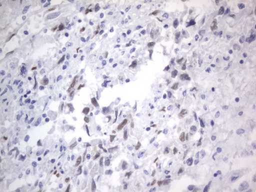 RBFOX1 / A2BP1 Antibody - IHC of paraffin-embedded Adenocarcinoma of Human ovary tissue using anti-RBFOX1 mouse monoclonal antibody. (Heat-induced epitope retrieval by 1 mM EDTA in 10mM Tris, pH8.5, 120°C for 3min).