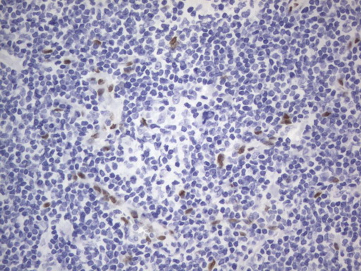 RBFOX1 / A2BP1 Antibody - IHC of paraffin-embedded Human lymphoma tissue using anti-RBFOX1 mouse monoclonal antibody. (Heat-induced epitope retrieval by 1 mM EDTA in 10mM Tris, pH8.5, 120°C for 3min).