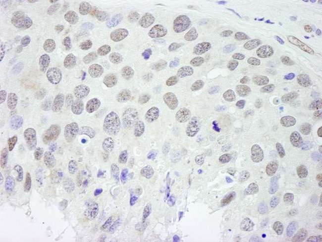 RBFOX2 / RBM9 Antibody - Detection of Human RBM9 by Immunohistochemistry. Sample: FFPE section of human breast carcinoma. Antibody: Affinity purified rabbit anti-RBM9 used at a dilution of 1:250.