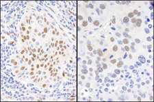 RBFOX2 / RBM9 Antibody - Detection of Human and Mouse Immunohistochemistry. Sample: FFPE sections of human lung carcinoma (left) and mouse renal cell carcinoma (right). Antibody: Affinity purified rabbit anti-No. Lot2) used at a dilution of 1:1000 (1 ug/ml). Detection: DAB.