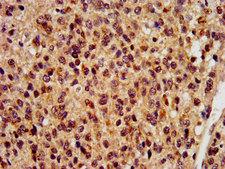 RBFOX2 / RBM9 Antibody - Immunohistochemistry image at a dilution of 1:400 and staining in paraffin-embedded human glioma cancer performed on a Leica BondTM system. After dewaxing and hydration, antigen retrieval was mediated by high pressure in a citrate buffer (pH 6.0) . Section was blocked with 10% normal goat serum 30min at RT. Then primary antibody (1% BSA) was incubated at 4 °C overnight. The primary is detected by a biotinylated secondary antibody and visualized using an HRP conjugated SP system.